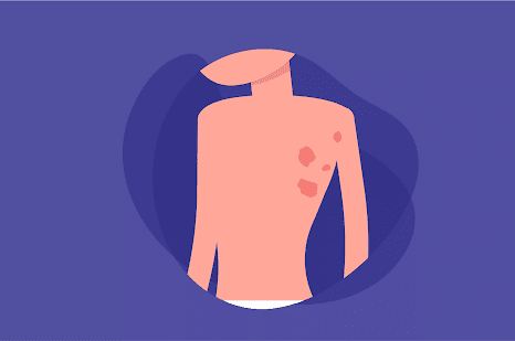 5 Kebiasaan yang Tingkatkan Risiko Dermatitis Numularis