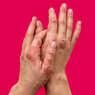 Dermatitis & Eksem